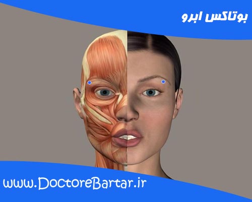 بوتاکس ابرو