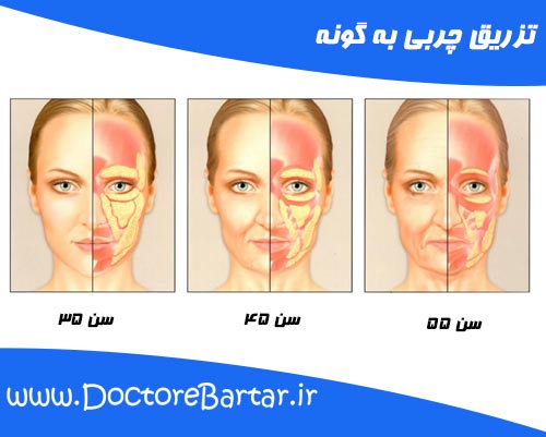 تزریق چربی به گونه