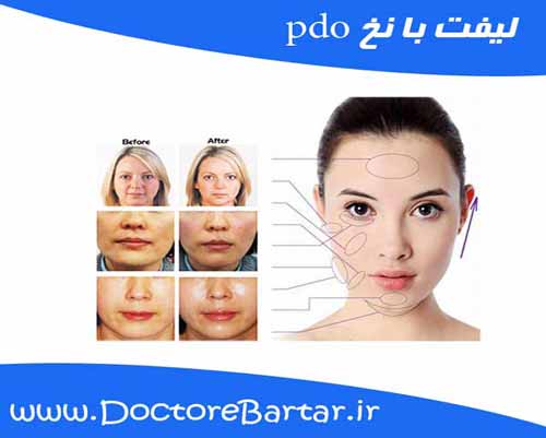 لیفت با نخ