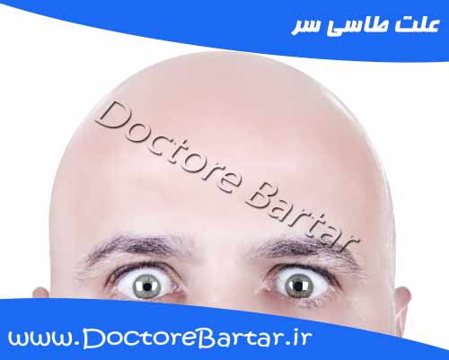 علائم و دلایل ریزش مو و طاسی سر