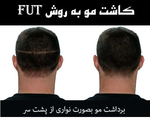 کاشت مو به روش FUT
