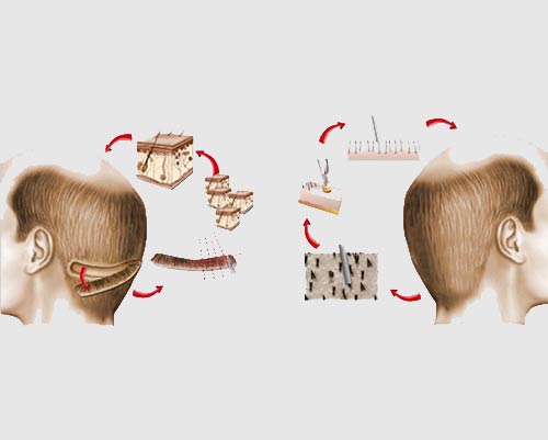 کاشت مو طبیعی به روش FIT