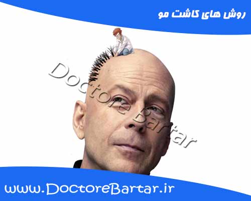 روش های کاشت مو