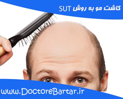 SUT کاشت مو به روش