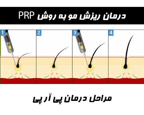 درمان ریزش مو با پی آر پی (PRP)