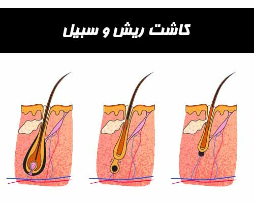 کاشت ریش و سبیل