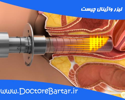 لیزر واژینال چیست؟