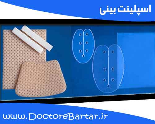 اسپلینت بینی