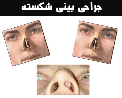 جراحی بینی شکسته
