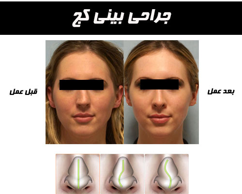 جراحی بینی کج