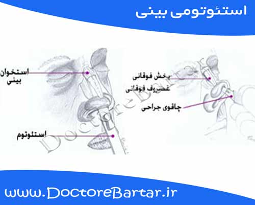 جراحی بینی