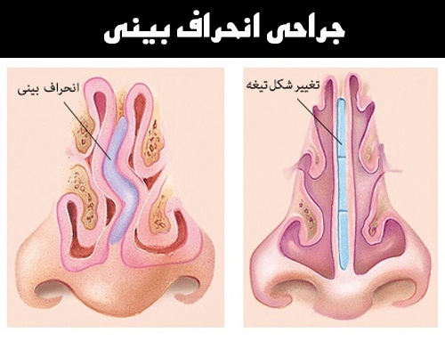 جراحی انحراف بینی