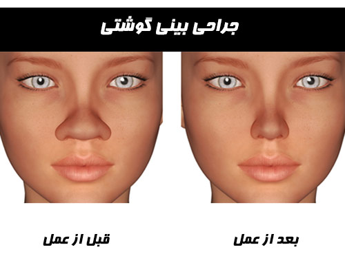 بینی گوشتی