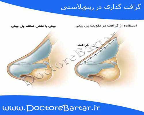 جراحی بینی