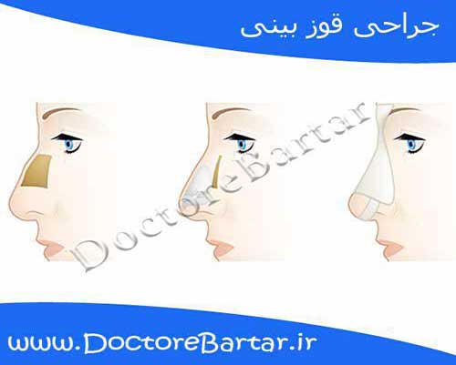 جراحی بینی