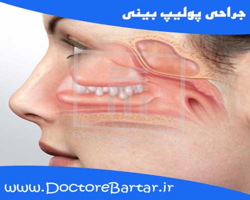 جراحی پولیپ بینی