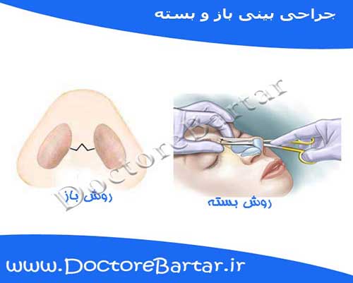 جراحی بینی باز و بسته