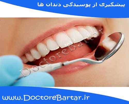 پیشگیری از پوسیدگی دندان ها