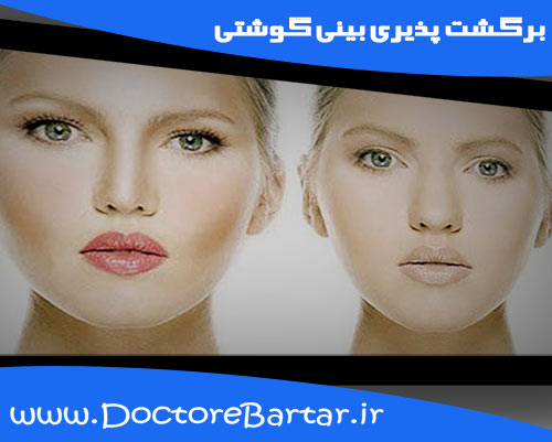 برگشت پذیری بینی گوشتی