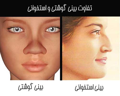 تفاوت بینی گوشتی و استخوانی