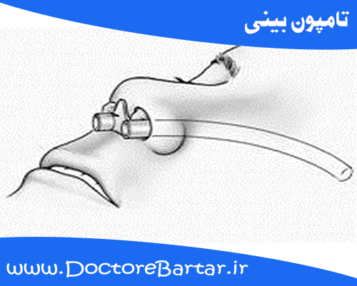 تامپون بینی