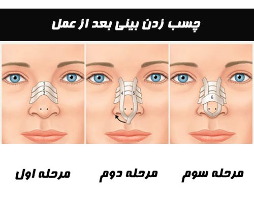 چسب زدن بینی بعد از عمل