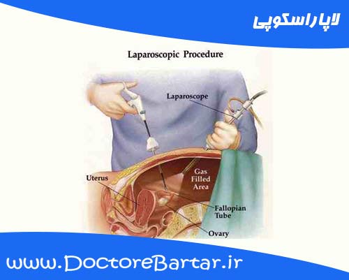 لاپاراسکوپی