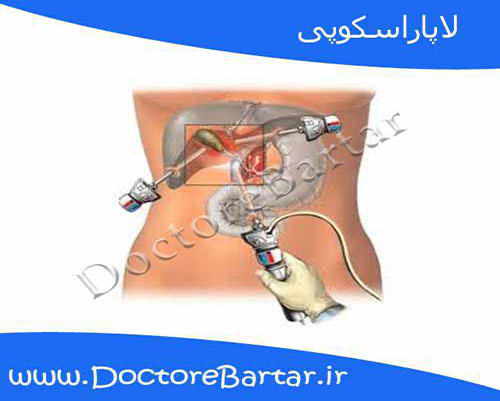 لاپاراسکوپی