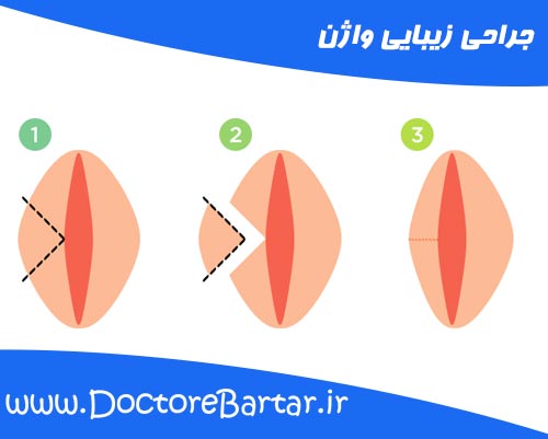 جراحی زیبایی واژن