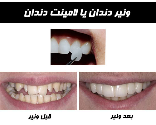 لامینت دندان یا ونیر دندان