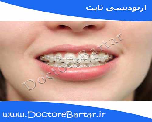 ارتودنسی ثابت
