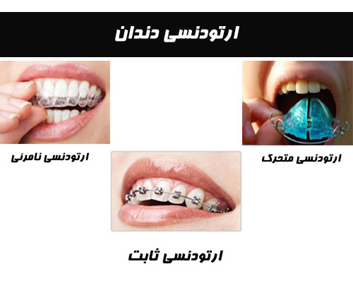 ارتودنسی یا ردیف کردن دندانها