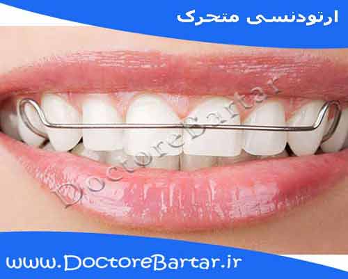ارتودنسی متحرک