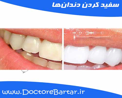سفید کردن دندانها