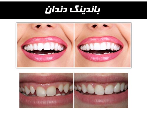 باندیگ دندان