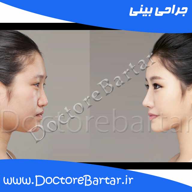 جراحی بینی