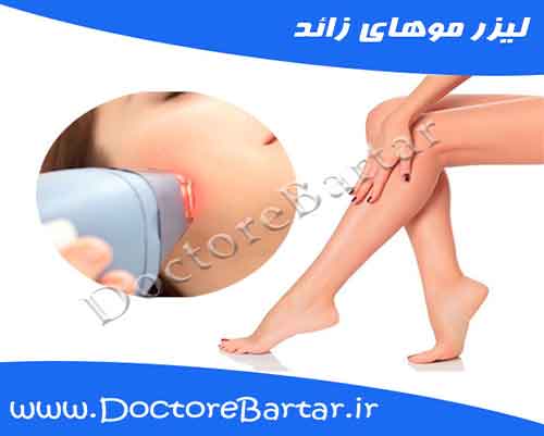رفع موهای زائد با لیزر